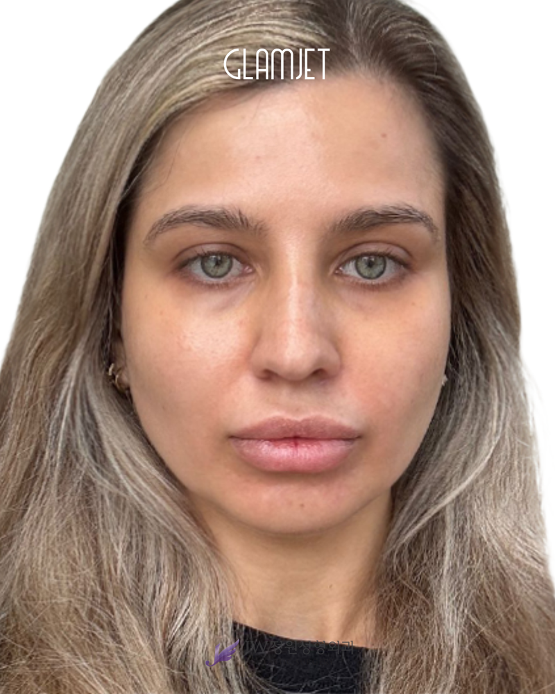 Before - Dr. Man: Revision rib cartilage rhinoplasty, hump removal, correction of deviated nose, collapsed nostril