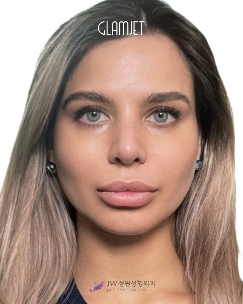 After - Dr. Man: Revision rib cartilage rhinoplasty, hump removal, correction of deviated nose, collapsed nostril