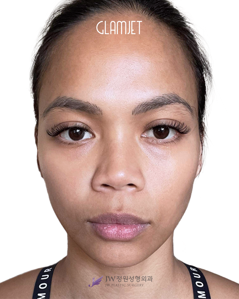 Before - Dr. Man: 3D INNORIB rib cartilage rhinoplasty revision, short nose correction, tipplasty