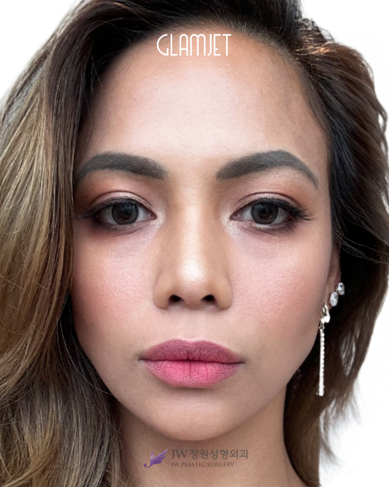 After - Dr. Man: 3D INNORIB rib cartilage rhinoplasty revision, short nose correction, tipplasty