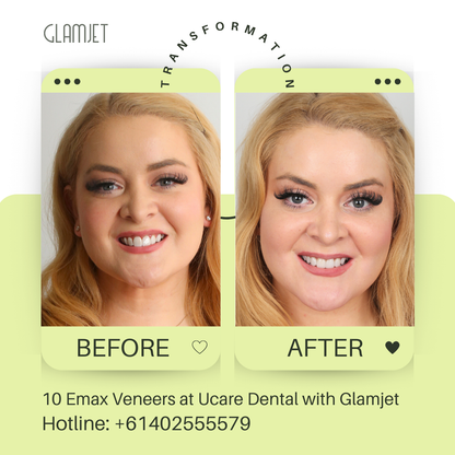 Before and after image of an Australian client travelling to Vietnam to replace old damaged porcelain veneers with Emax Ceramic Veneers with minimal dental preparation at Ucare Dental Clinic in Ho Chi Minh city, Vietnam. Glamjet Dental Holiday combines expert dental care at top rated dental clinics with breathtaking travel experiences in Hanoi, Ho Chi Minh City, and Da Nang. Glamjet's medical concierge service is trusted by many clients in Australians, New Zealand, and the USA. 