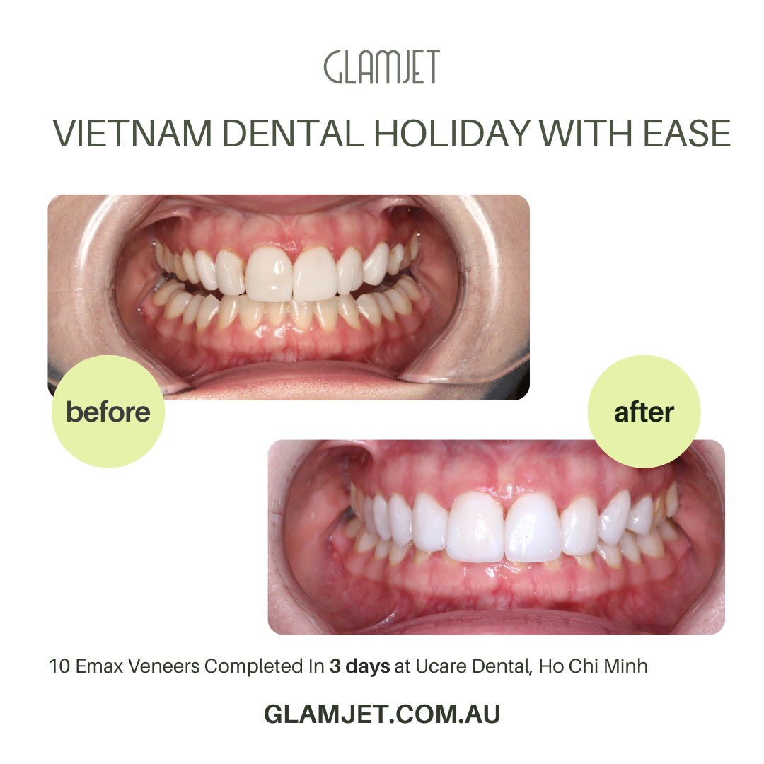 Wonderful image of before and after veneers replacement in a top rated dental clinic in Ho Chi Minh city, Vietnam. An Australian client had damaged porcelain veneers with shapes and color that she doesn't like. She used medical concierge service of Glamjet and transform her smile to bright, white and with shapes more proportion to her face. Glamjet Dental Holiday is very affordable for Australians, New Zealanders, and Americans with the best dentists in Vietnam and payment plans. 