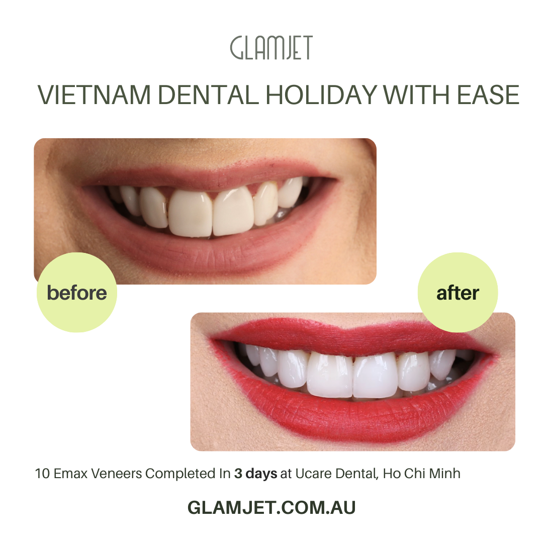 Before and after image of an Australian client travelling to Vietnam to replace old damaged porcelain veneers with Emax Ceramic Veneers with minimal dental preparation at Ucare Dental Clinic in Ho Chi Minh city, Vietnam. It is a stunning transformation. Glamjet Dental Holiday combines expert dental care at top rated dental clinics with  travel experiences in Hanoi, Ho Chi Minh City, and Da Nang. Glamjet's medical concierge service is trusted by many clients in Australians, New Zealand, and the USA. 