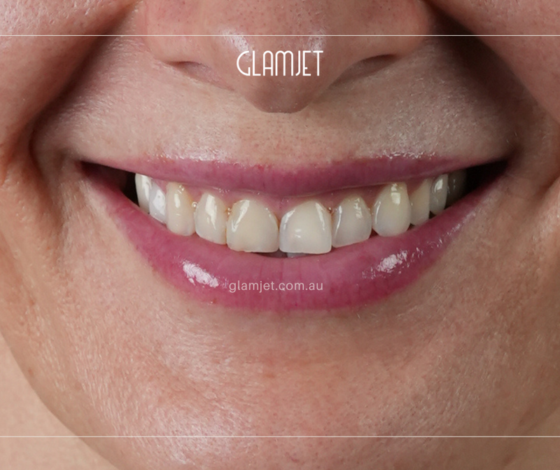 Before - Case 3: 9 Emax veneers and 1 zirconia crown