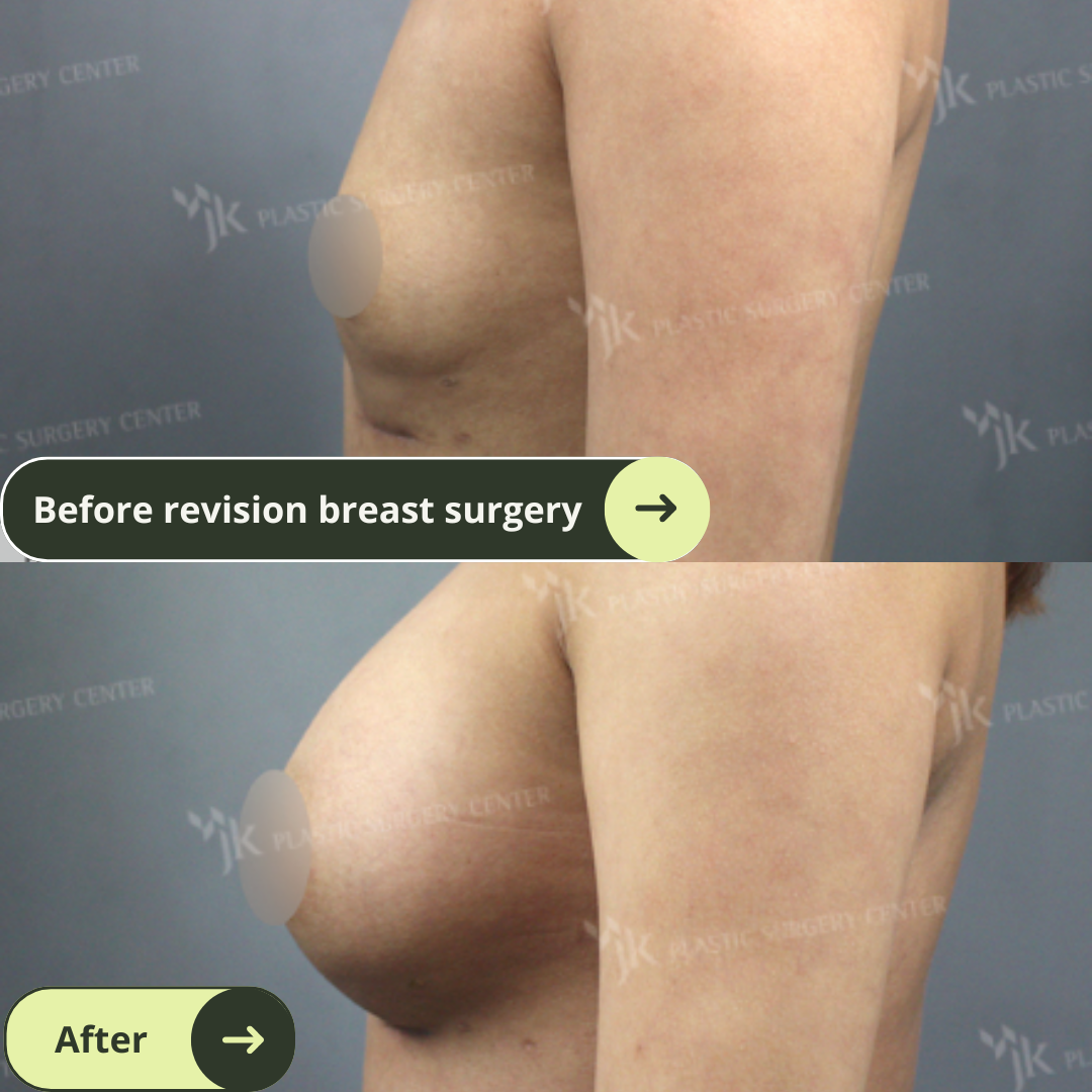 Breast Augmentation Surgery Packages In South Korea