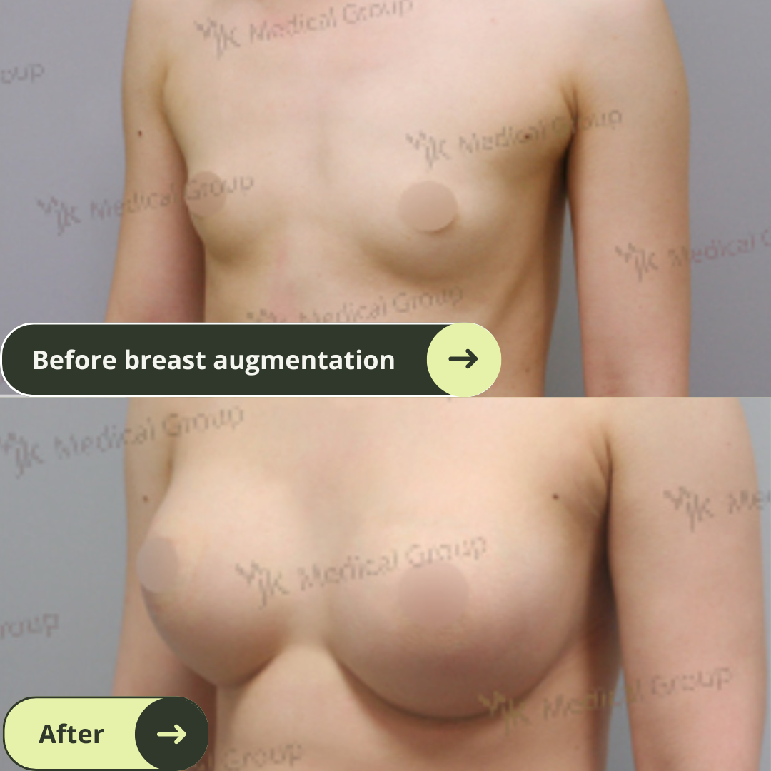 Breast Augmentation Surgery Packages In South Korea