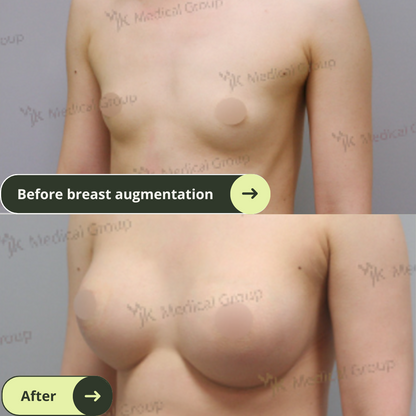 Breast Augmentation Surgery Packages In South Korea