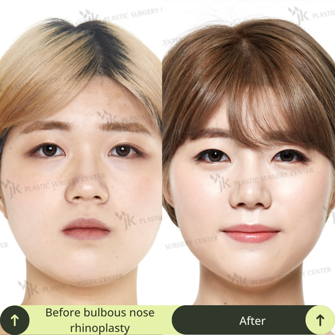 Women Rhinoplasty Surgery Packages In South Korea