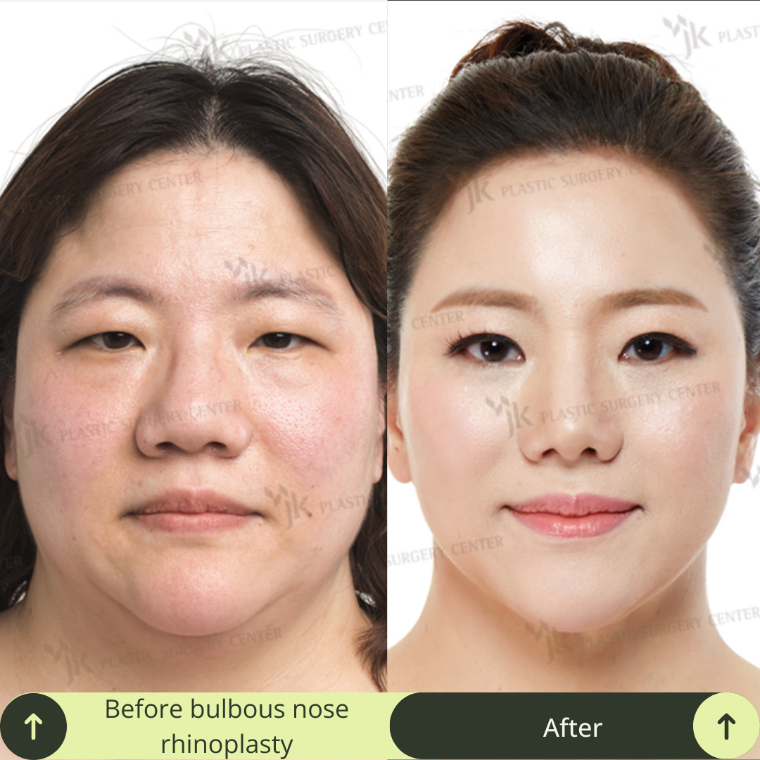 Women Rhinoplasty Surgery Packages In South Korea