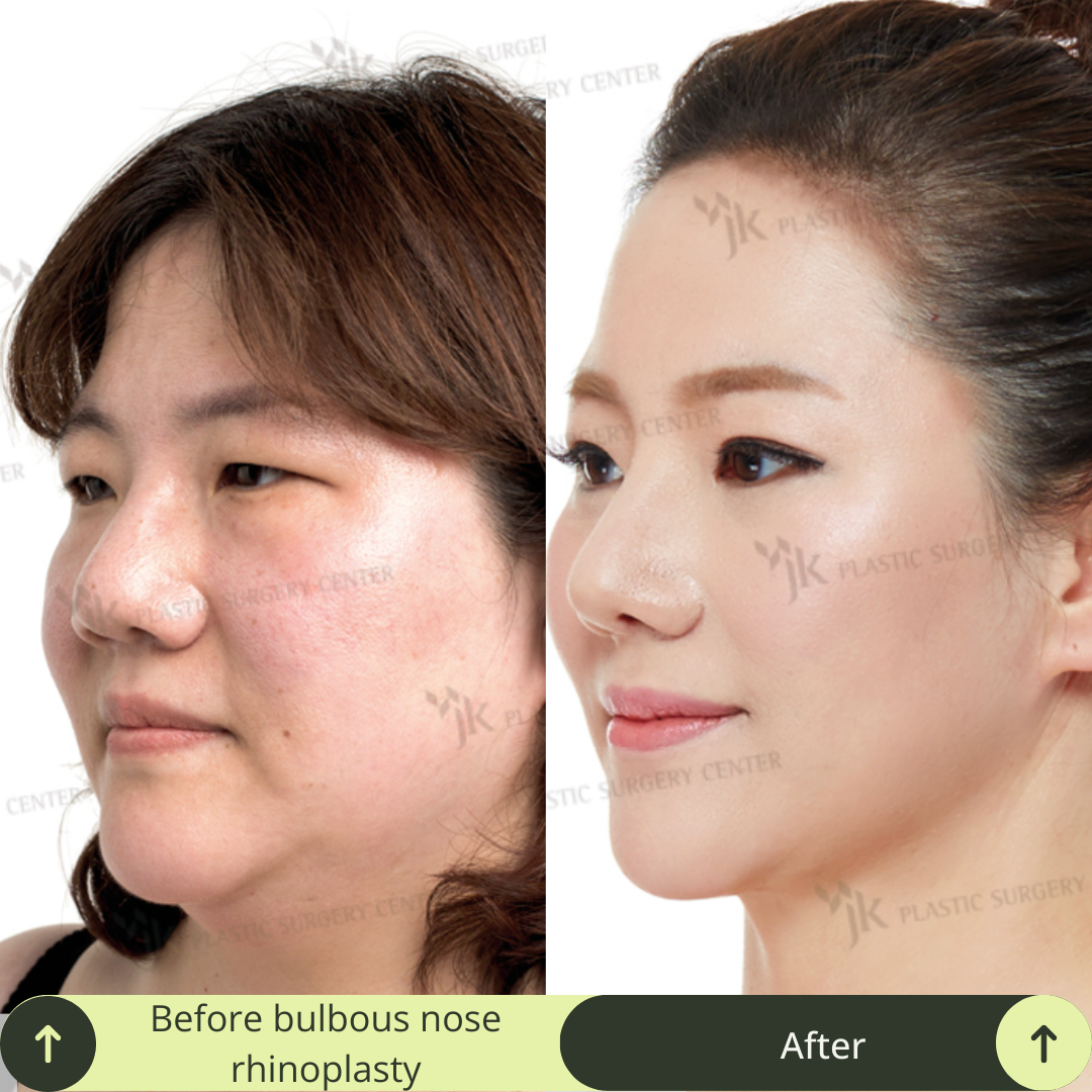 Women Rhinoplasty Surgery Packages In South Korea