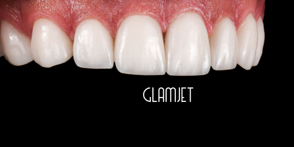 Hybrid Composite Veneer
