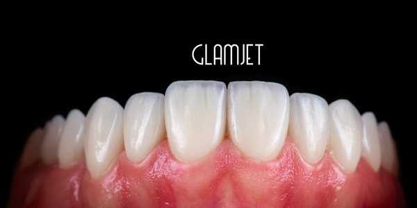 Hybrid Composite Veneer