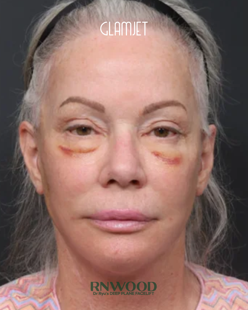 After - Revision deep plane face lift, revision neck lift with submentoplasty, lower blepharoplasty, full face fat graft