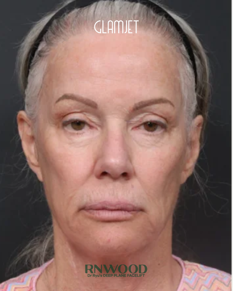 Before - Revision deep plane face lift, revision neck lift with submentoplasty, lower blepharoplasty, full face fat graft