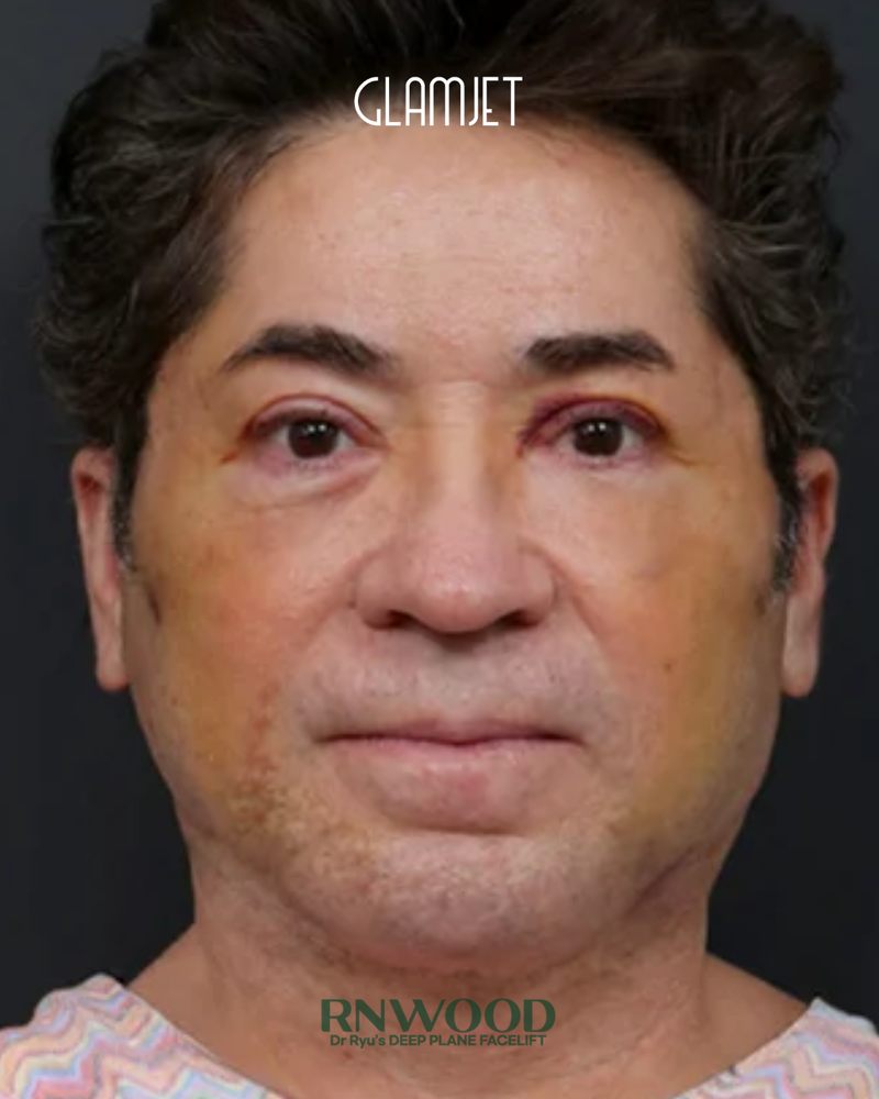 After - Deep plane facelift, neck lift with submentoplasty, facial fat graft, endoscopic forehead lift, lower blepharoplasty