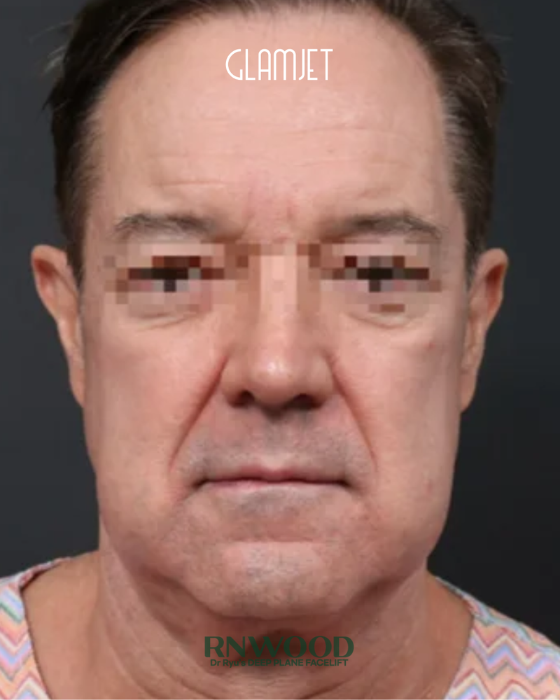 Before - Deep plane facelift, neck lift with submentoplasty, stem cells facial fat graft, endoscopic forehead lift, lower blepharoplasty