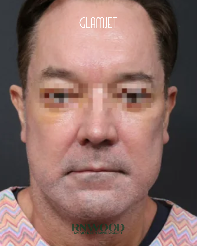 After - Deep plane facelift, neck lift with submentoplasty, stem cells facial fat graft, endoscopic forehead lift, lower blepharoplasty
