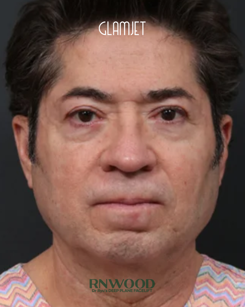 Before - Deep plane facelift, neck lift with submentoplasty, facial fat graft, endoscopic forehead lift, lower blepharoplasty