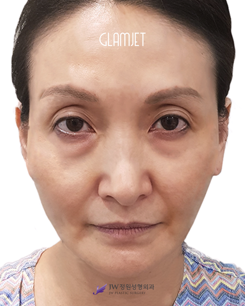 Before - Extended SMAS face lift  and neck lift, facial fat graft, upper blepharoplasty, lower blepharoplasty with upper cheek lift