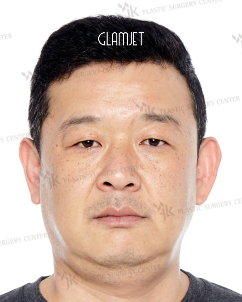 Before - Deep plane facelift, neck lift, facial liposuction, double eye lid surgery, lower blepharoplasty, rhinoplasty