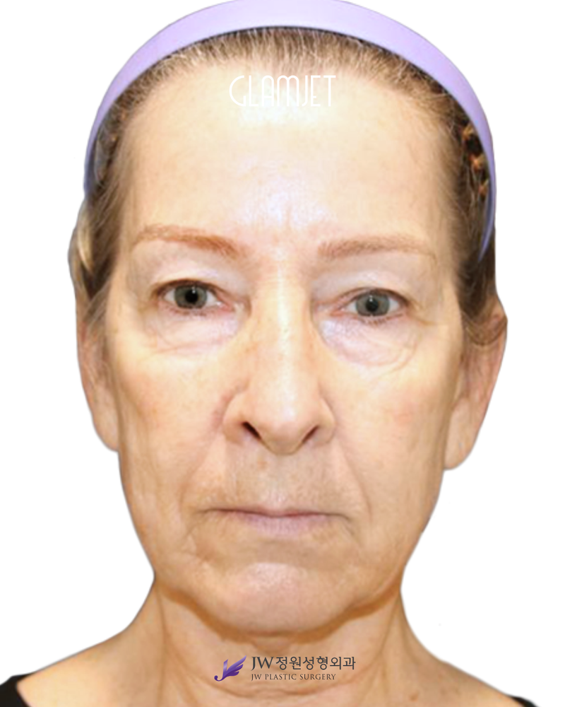 Before - Deep plane facelift, neck lift, endoscopic forehead lift, facial fat graft, upper blepharoplasty, lower blepharoplasty, laser resurfacing, lip filler.
