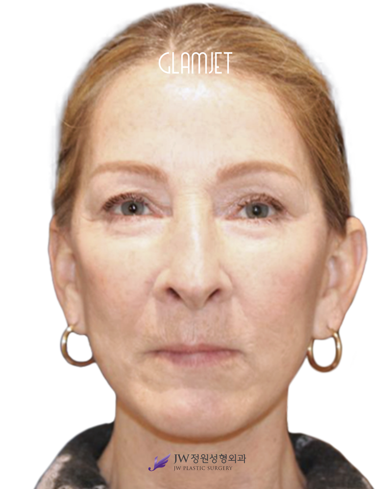 After - Deep plane facelift, neck lift, endoscopic forehead lift, facial fat graft, upper blepharoplasty, lower blepharoplasty, laser resurfacing, lip filler.