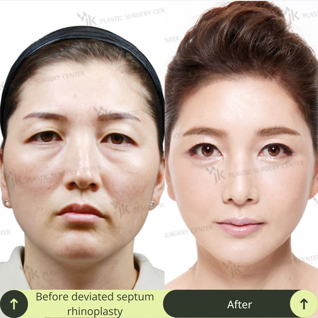 Women Rhinoplasty Surgery Packages In South Korea