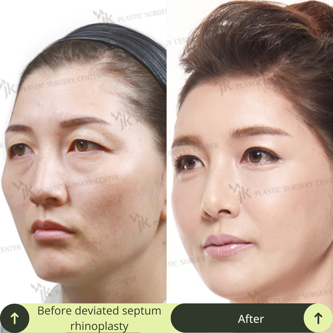 Women Rhinoplasty Surgery Packages In South Korea