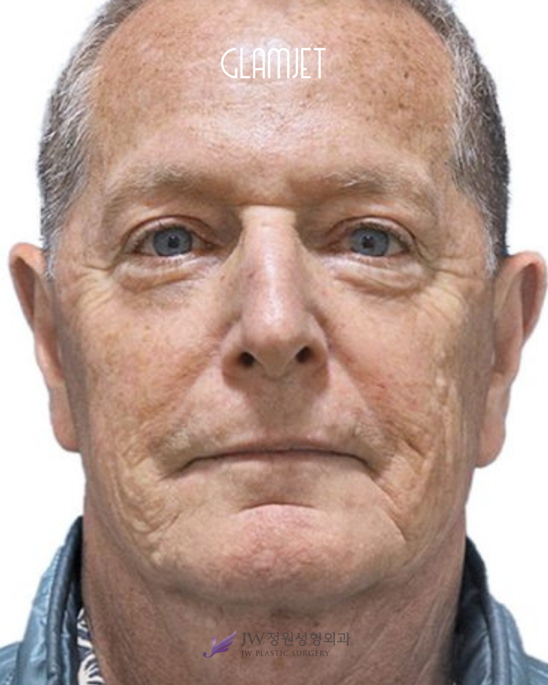 Before - Deep plane face lift, neck lift with neck muscle tight, upper and lower blepharoplasty . full face fat graft