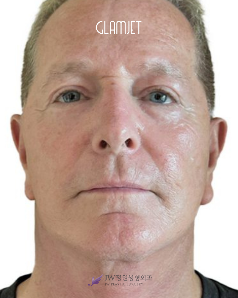 After - Deep plane face lift, neck lift with neck muscle tight, upper and lower blepharoplasty . full face fat graft