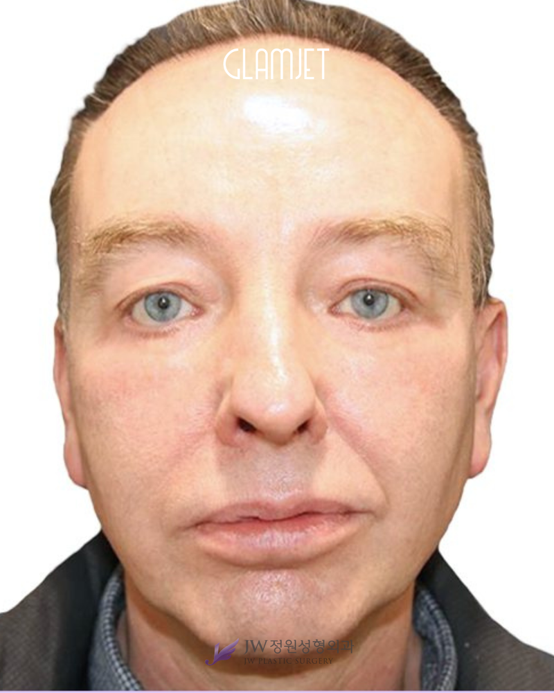 After - Deep plane face & neck lift, endoscopic forehead lift, brow lift, extended lower blepharoplasty with upper cheek lift