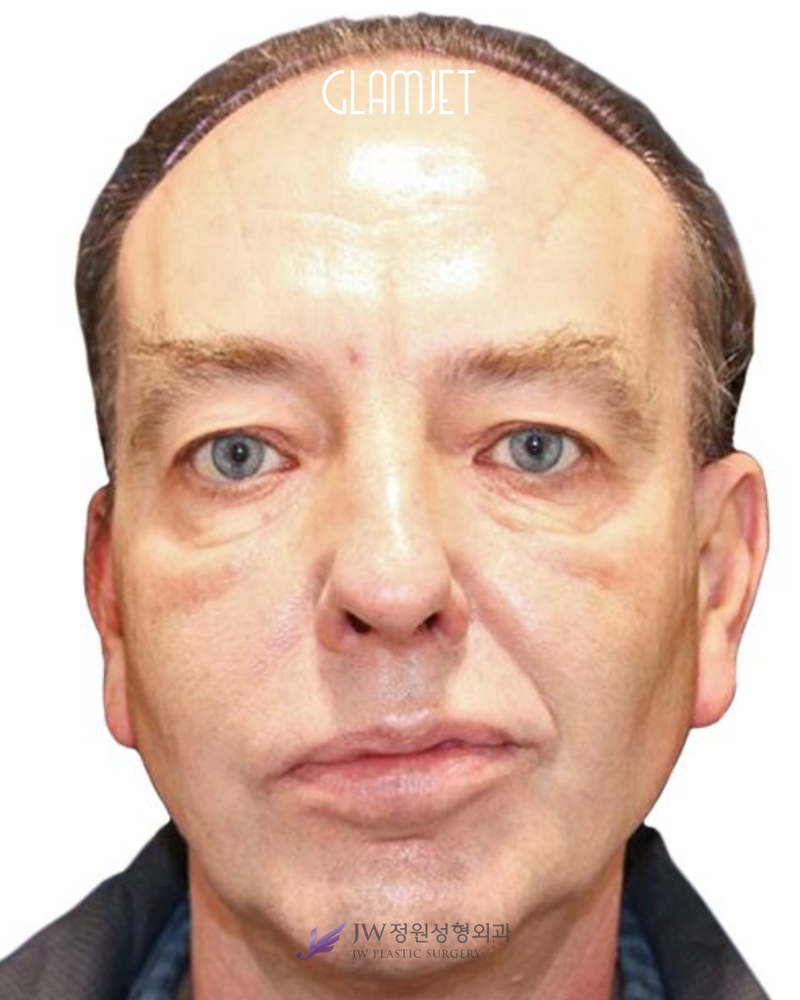 Before - Deep plane face & neck lift, endoscopic forehead lift, brow lift, extended lower blepharoplasty with upper cheek lift