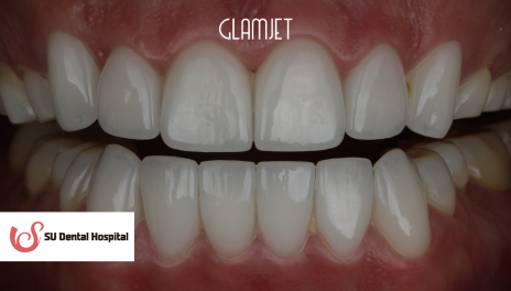 After - Comprehensive Smile Makeover
