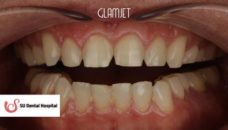 Before - Emax Veneers