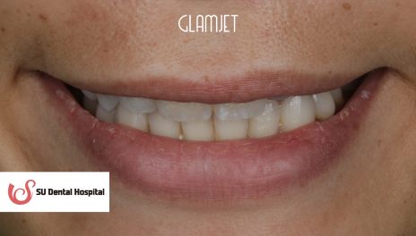 Before - Comprehensive Smile Makeover