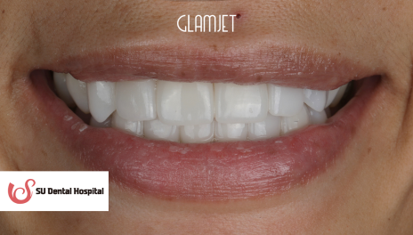 After - Comprehensive Smile Makeover