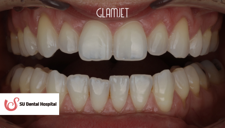 Before - Comprehensive Smile Makeover