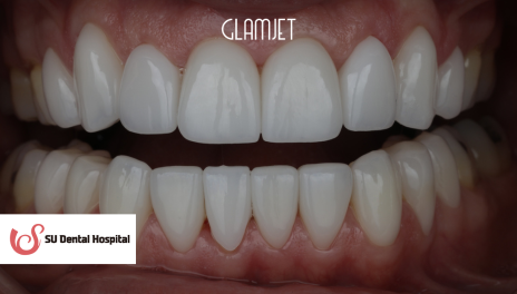 After - Emax Veneers