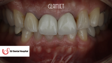 Before - Veneers