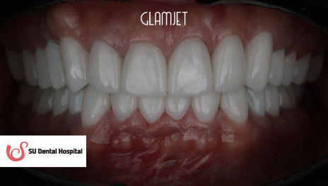 After - Veneers