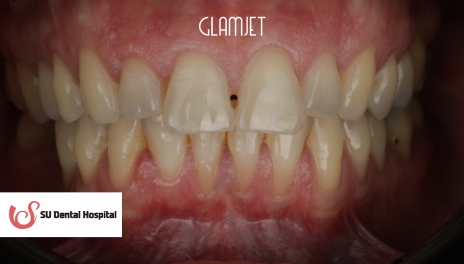 Before - Emax Veneers