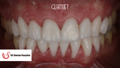 After - Emax Veneers
