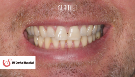 Before - Veneers