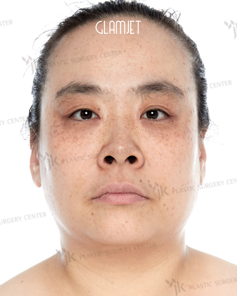 Before - Deep plane face & neck lift with muscle tie, forehead lift, upper blepharoplasty, lower blepharoplasty with upper cheek lift, liposuction, rhinoplasty, skin laser & boosters.