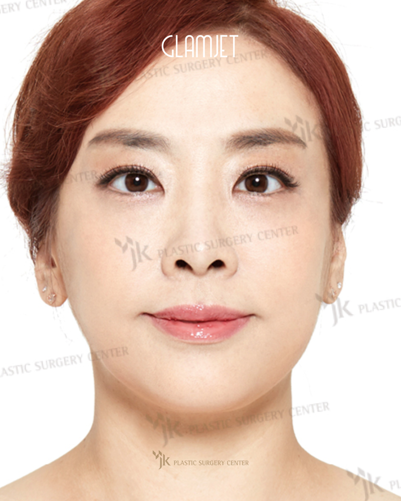 After - Deep plane face & neck lift with muscle tie, forehead lift, upper blepharoplasty, lower blepharoplasty with upper cheek lift, liposuction, rhinoplasty, skin laser & boosters.