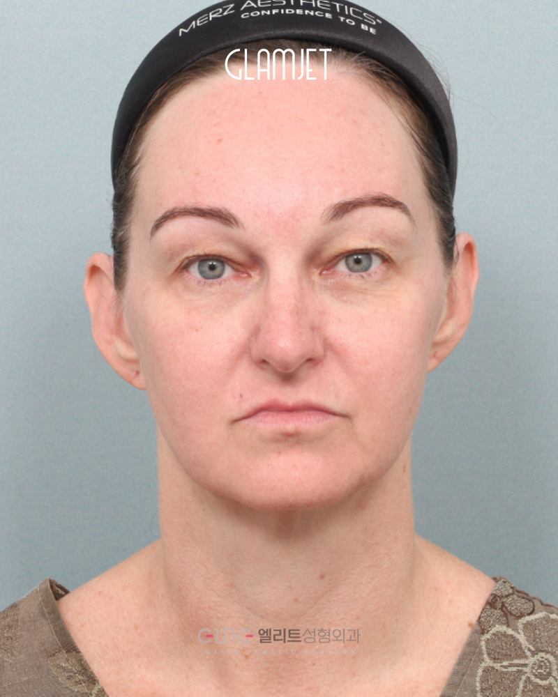 Before - Deep plane face & neck lift, endoscopic forehead lift, brow Lift, extended lower blepharoplasty with upper cheek lift, lip filler
