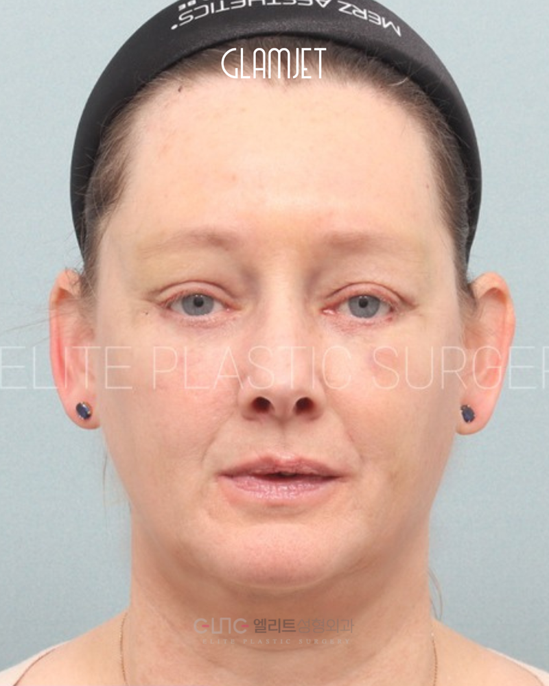 After - Deep plane facelift, neck lift with submentoplasty, facial fat graft, and endoscopic forehead lift, upper blepharoplasty