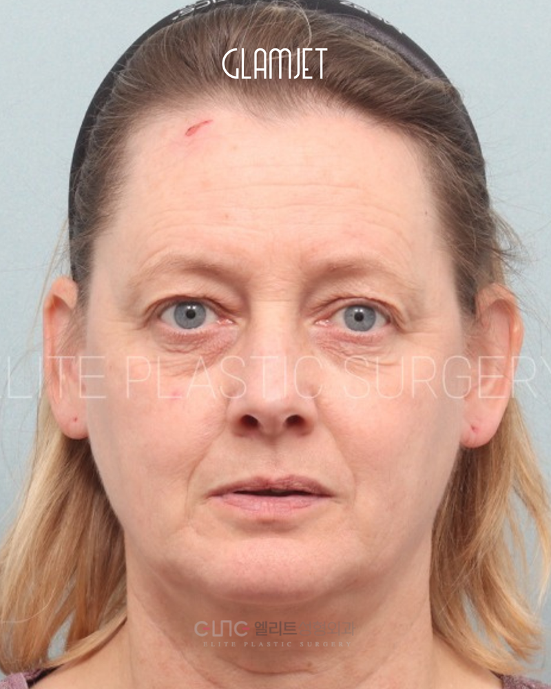 Before - Deep plane facelift, neck lift with submentoplasty, facial fat graft, and endoscopic forehead lift, upper blepharoplasty