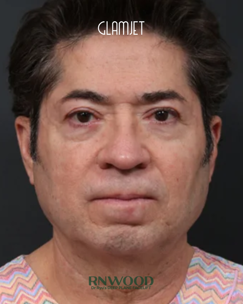 Before - Deep plane facelift, neck lift with submentoplasty, facial fat graft, and endoscopic forehead lift