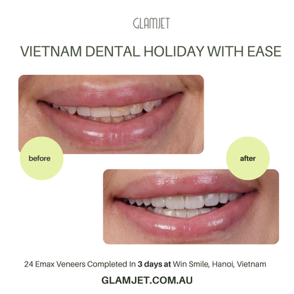 Smile transformation with Emax Ceramic Veneers at Ucare Dental Clinic, Hanoi. Glamjet Dental Holiday offers premium no-prep and minimum preparation veneer services and exciting Vietnam travel experiences. Glamjet work with the best dentists in Hanoi and Ho Chi Minh city, Vietnam. Glamjet helps many Australians, Americans, and New Zealanders arrange dental tourism to Vietnam with ease. 